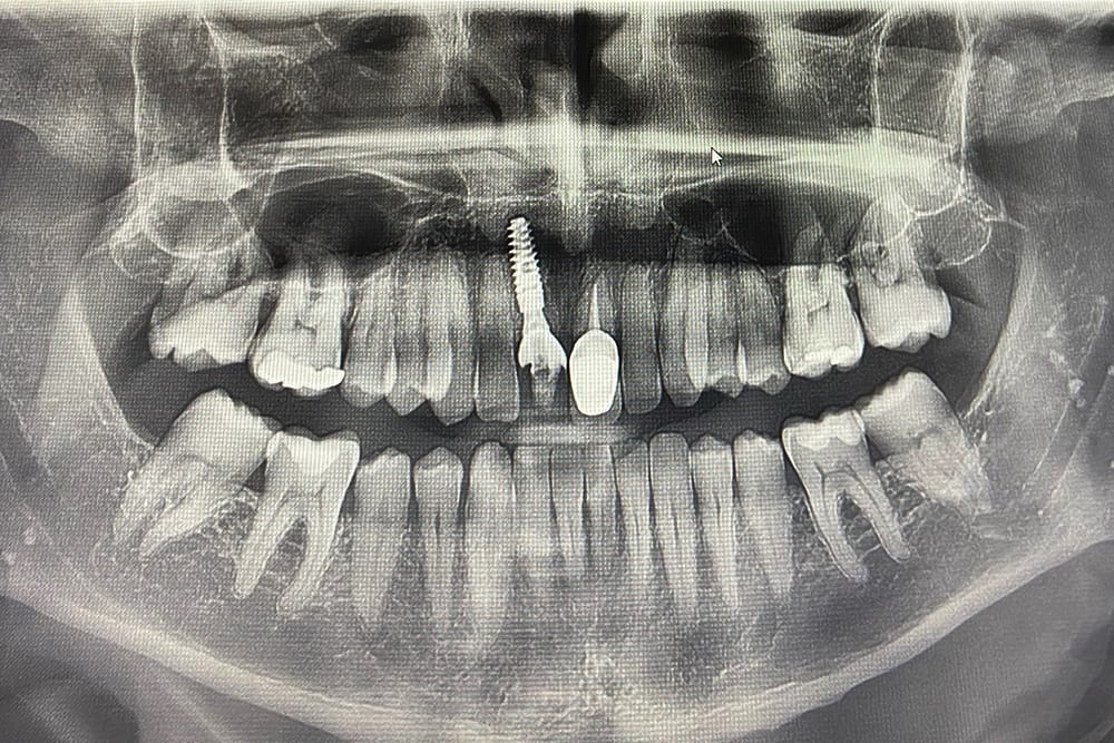 Implant dentaire Strasbourg EMCI 5